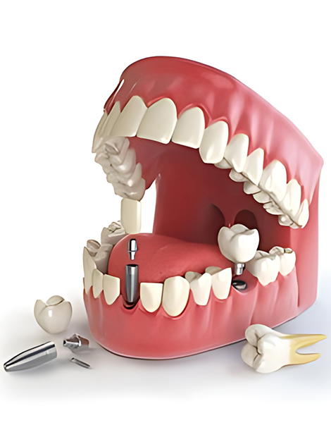 Dental implants in Karimnagar
